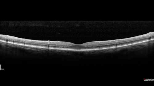 Hydroxychloroquine Toxicity - Mild
71 year old female with 200 mg BID plaquenil for 25 years.  Recent visual field showed abnomality.  FAF shows hyper FAF temporally and OCT shows mild outer retinal atrophy

