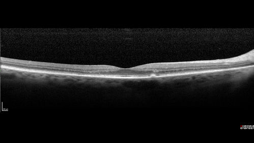 Hydroxychloroquine Toxicity - Mild
71 year old female with 200 mg BID plaquenil for 25 years.  Recent visual field showed abnomality.  FAF shows hyper FAF temporally and OCT shows mild outer retinal atrophy
