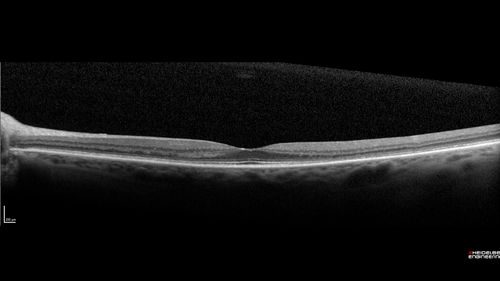 Hydroxychloroquine Toxicity - Mild
71 year old female with 200 mg BID plaquenil for 25 years.  Recent visual field showed abnomality.  FAF shows hyper FAF temporally and OCT shows mild outer retinal atrophy
