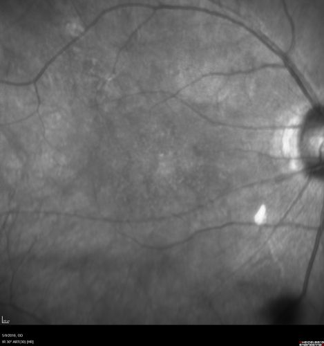 Diffuse outer retinal atrophy in 51 year old woman with 22 years plaquenil (hydroxychlorquine) use
Retinitis pigmentosa or similar dystrophy vs plaquenil toxicity
