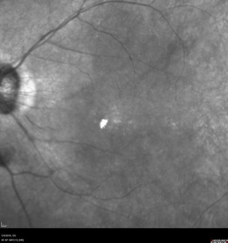hydroxychloroquine (Plaquenil) Toxicity - Taiwanese 56 year old female (Asian)
56 year old female on 400 mg plaquenil for 22 years presents with vision loss.  VA 20/50 both eyes.  Plaquenil was stopped.  The vision in the left eye continued to deteriorate to 3/200.  5'2" 127 lb (6.6 mg/kg body weight)
