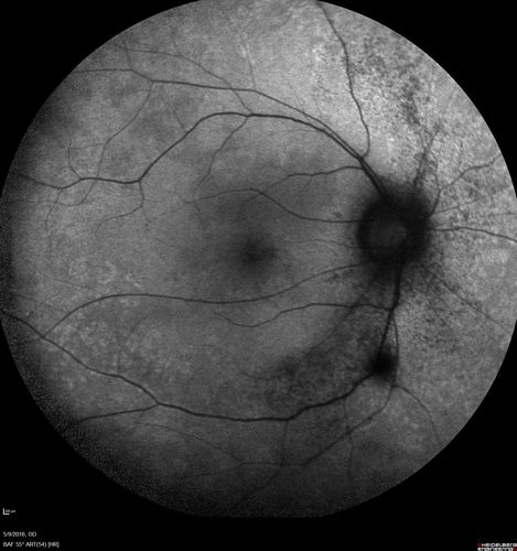 hydroxychloroquine (Plaquenil) Toxicity - Taiwanese 56 year old female (Asian)
56 year old female on 400 mg plaquenil for 22 years presents with vision loss.  VA 20/50 both eyes.  Plaquenil was stopped.  The vision in the left eye continued to deteriorate to 3/200.  5'2" 127 lb (6.6 mg/kg body weight)

