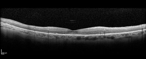 Diffuse outer retinal atrophy in 51 year old woman with 22 years plaquenil (hydroxychlorquine) use
Retinitis pigmentosa or similar dystrophy vs plaquenil toxicity
