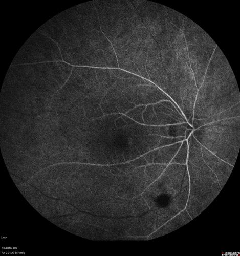 hydroxychloroquine (Plaquenil) Toxicity - Taiwanese 56 year old female (Asian)
56 year old female on 400 mg plaquenil for 22 years presents with vision loss.  VA 20/50 both eyes.  Plaquenil was stopped.  The vision in the left eye continued to deteriorate to 3/200.  5'2" 127 lb (6.6 mg/kg body weight)
