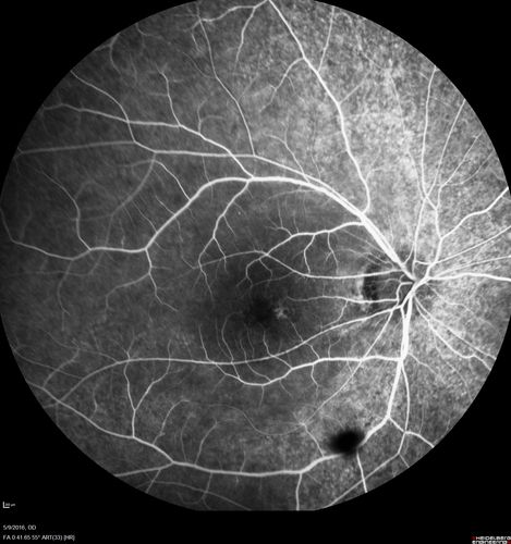 hydroxychloroquine (Plaquenil) Toxicity - Taiwanese 56 year old female (Asian)
56 year old female on 400 mg plaquenil for 22 years presents with vision loss.  VA 20/50 both eyes.  Plaquenil was stopped.  The vision in the left eye continued to deteriorate to 3/200.  5'2" 127 lb (6.6 mg/kg body weight)
