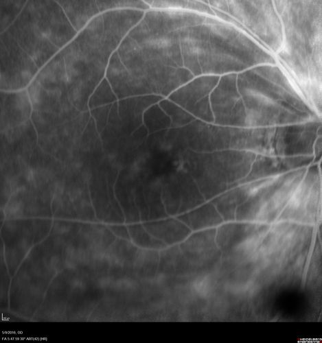 hydroxychloroquine (Plaquenil) Toxicity - Taiwanese 56 year old female (Asian)
56 year old female on 400 mg plaquenil for 22 years presents with vision loss.  VA 20/50 both eyes.  Plaquenil was stopped.  The vision in the left eye continued to deteriorate to 3/200.  5'2" 127 lb (6.6 mg/kg body weight)
