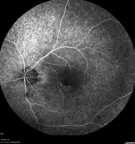 Diffuse outer retinal atrophy in 51 year old woman with 22 years plaquenil (hydroxychlorquine) use
Retinitis pigmentosa or similar dystrophy vs plaquenil toxicity
