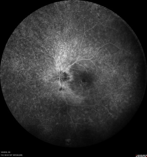 Diffuse outer retinal atrophy in 51 year old woman with 22 years plaquenil (hydroxychlorquine) use
Retinitis pigmentosa or similar dystrophy vs plaquenil toxicity
