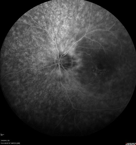 hydroxychloroquine (Plaquenil) Toxicity - Taiwanese 56 year old female (Asian)
56 year old female on 400 mg plaquenil for 22 years presents with vision loss.  VA 20/50 both eyes.  Plaquenil was stopped.  The vision in the left eye continued to deteriorate to 3/200.  5'2" 127 lb (6.6 mg/kg body weight)
