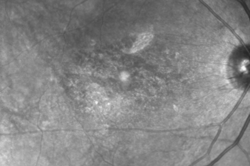 Plaquenil Toxicity - Bull's Eye Maculopathy - 25 Years Therapy - InfraRed Image
73-year-old woman has been on Plaquenil for twenty five years. Plaquenil has now been stopped for 6 months.  VA continues to decline as does visual function - 20/80 OD , 20/40 OS
