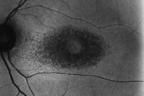 Plaquenil Toxicity - Bull's Eye Maculopathy - 25 Years Therapy - Fundus Autofluorescence
73-year-old woman has been on Plaquenil for twenty five years. Plaquenil has now been stopped for 6 months.  VA continues to decline as does visual function - 20/80 OD , 20/40 OS
