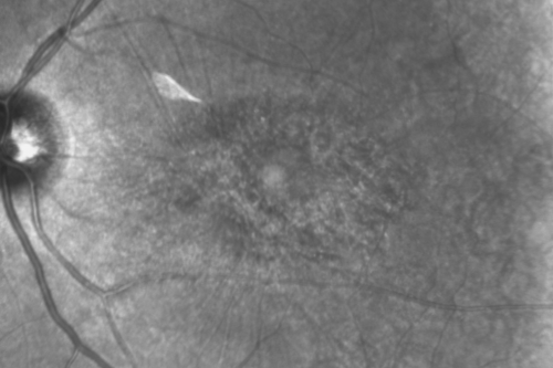 Plaquenil Toxicity - Bull's Eye Maculopathy - 25 Years Therapy - Infra-red Image
73-year-old woman has been on Plaquenil for twenty five years. Plaquenil has now been stopped for 6 months.  VA continues to decline as does visual function - 20/80 OD , 20/40 OS
