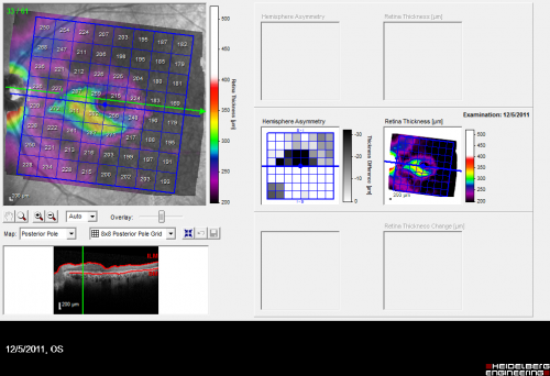 Plaquenil Toxicity - Bull's Eye Maculopathy - 25 Years Therapy - OCT Posterior Pole MAP
73-year-old woman has been on Plaquenil for twenty five years. Plaquenil has now been stopped for 6 months.  VA continues to decline as does visual function - 20/80 OD , 20/40 OS
