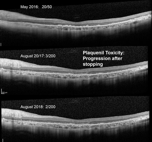 hydroxychloroquine (Plaquenil) Toxicity - Taiwanese 56 year old female (Asian)
56 year old female on 400 mg plaquenil for 22 years presents with vision loss.  VA 20/50 both eyes.  Plaquenil was stopped.  The vision in the left eye continued to deteriorate to 3/200.  5'2" 127 lb (6.6 mg/kg body weight)
