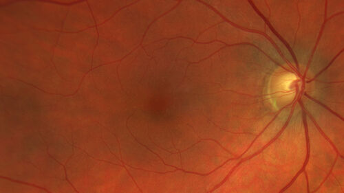 Hydroxychloroquine Toxicity
60 year old female received 6.5 mg/kg Plaquenil for 15 years and developed toxicity.  VA 20/40 OD, 20/20 OS
