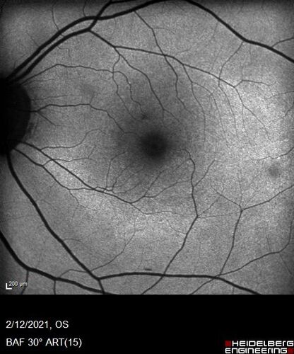 Hydroxychloroquine Toxicity
60 year old female received 6.5 mg/kg Plaquenil for 15 years and developed toxicity.  VA 20/40 OD, 20/20 OS
