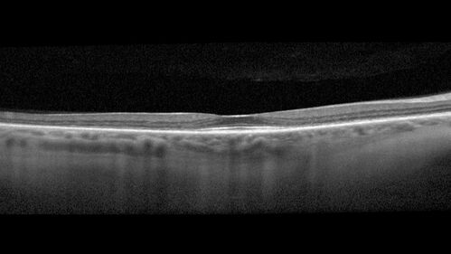 Hydroxychloroquine Toxicity
60 year old female received 6.5 mg/kg Plaquenil for 15 years and developed toxicity.  VA 20/40 OD, 20/20 OS
