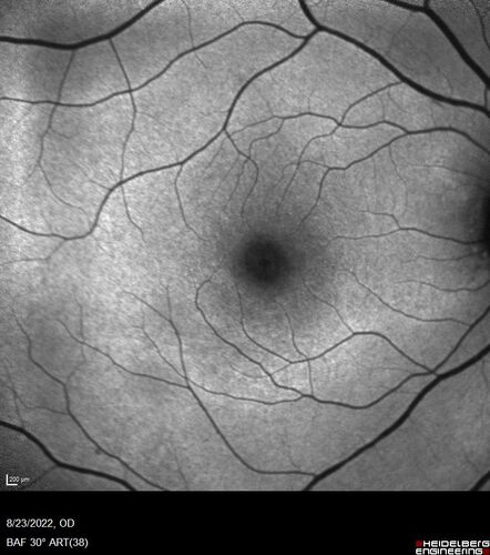 Hydroxychloroquine Toxicity
60 year old female received 6.5 mg/kg Plaquenil for 15 years and developed toxicity.  VA 20/40 OD, 20/20 OS
