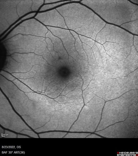 Hydroxychloroquine Toxicity
60 year old female received 6.5 mg/kg Plaquenil for 15 years and developed toxicity.  VA 20/40 OD, 20/20 OS
