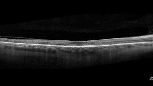 Hydroxychloroquine Toxicity
60 year old female received 6.5 mg/kg Plaquenil for 15 years and developed toxicity.  VA 20/40 OD, 20/20 OS
