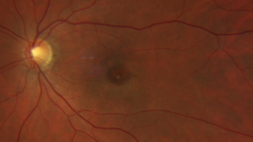 Plaquenil Toxicity - 4 years use
47 year old female She started plaquenil 4 years ago for lupus with cutaneous findings.  She has never been on the plaquenil before.  Her renal function is normal (her husband is an internist) and she is not on Tamoxifen.  Stopped the medication about 2.5 weeks ago.  She noticed vision when she started the depacote.  She is also myopic. (-9.50)  

Her dose was 6.3 mg/kg.  She is 5'1