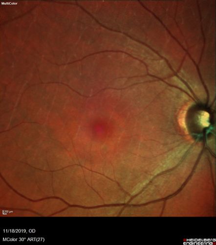 Plaquenil Toxicity - 4 years use
47 year old female She started plaquenil 4 years ago for lupus with cutaneous findings.  She has never been on the plaquenil before.  Her renal function is normal (her husband is an internist) and she is not on Tamoxifen.  Stopped the medication about 2.5 weeks ago.  She noticed vision when she started the depacote.  She is also myopic. (-9.50)  

Her dose was 6.3 mg/kg.  She is 5'1