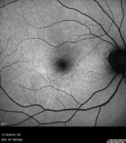 Plaquenil Toxicity - 4 years use
47 year old female She started plaquenil 4 years ago for lupus with cutaneous findings.  She has never been on the plaquenil before.  Her renal function is normal (her husband is an internist) and she is not on Tamoxifen.  Stopped the medication about 2.5 weeks ago.  She noticed vision when she started the depacote.  She is also myopic. (-9.50)  

Her dose was 6.3 mg/kg.  She is 5'1