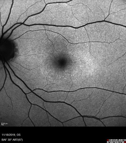 Plaquenil Toxicity - 4 years use
47 year old female She started plaquenil 4 years ago for lupus with cutaneous findings.  She has never been on the plaquenil before.  Her renal function is normal (her husband is an internist) and she is not on Tamoxifen.  Stopped the medication about 2.5 weeks ago.  She noticed vision when she started the depacote.  She is also myopic. (-9.50)  

Her dose was 6.3 mg/kg.  She is 5'1