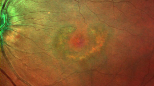 Hydroxychloroquine (plaquenil) Toxicity - Advanced
78 year old female No visual complaints referred for evaluation
Medical Hx: Rheumatoid Arthritis. Atrial Fibrillation. Benign Intracranial Hypertension. Sjogrens Syndrome. Osteoporosis. 
Systemic Meds: PLAQUENIL (Stopped 2 months ago). Leflunomide. Lidocaine. Gabapentin. Vitamin D. Multaq. DILTIAZEM.
VA OD: Dcc20/32-2 NccJ2
VA OS: Dcc20/25+1 NccJ1-1
IOP: TP: OD:14 OS:15 
Color Ishihara OD 9/11 correct, OS 9.5/11 correct
Weight 100 lbs, Height 4â€™ 2â€ tall.
1993 Plaquenil Initially 400 mg /day (9 mg/kg/day x 18 years) then 2011 200 mg daily - (4.6 mg/kg/day x 10 years) STOPPED 3/2021
The patient weighs 100 lbs and is 4â€™ 2â€ tall - Images are from 3/2021 and 5/2022
There was no progression 1 year after stopping plaquenil in this patient.
