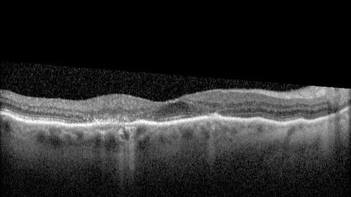 Hydroxychloroquine (plaquenil) Toxicity - Advanced
78 year old female No visual complaints referred for evaluation
Medical Hx: Rheumatoid Arthritis. Atrial Fibrillation. Benign Intracranial Hypertension. Sjogrens Syndrome. Osteoporosis. 
Systemic Meds: PLAQUENIL (Stopped 2 months ago). Leflunomide. Lidocaine. Gabapentin. Vitamin D. Multaq. DILTIAZEM.
VA OD: Dcc20/32-2 NccJ2
VA OS: Dcc20/25+1 NccJ1-1
IOP: TP: OD:14 OS:15 
Color Ishihara OD 9/11 correct, OS 9.5/11 correct
Weight 100 lbs, Height 4â€™ 2â€ tall.
1993 Plaquenil Initially 400 mg /day (9 mg/kg/day x 18 years) then 2011 200 mg daily - (4.6 mg/kg/day x 10 years) STOPPED 3/2021
The patient weighs 100 lbs and is 4â€™ 2â€ tall - Images are from 3/2021 and 5/2022
There was no progression 1 year after stopping plaquenil in this patient.
