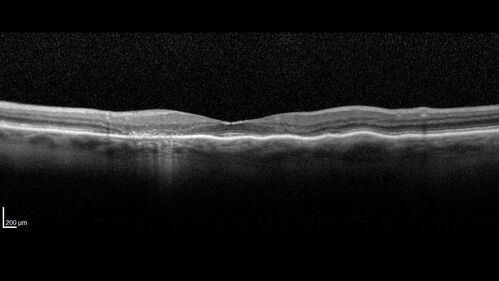 Hydroxychloroquine (plaquenil) Toxicity - Advanced
78 year old female No visual complaints referred for evaluation
Medical Hx: Rheumatoid Arthritis. Atrial Fibrillation. Benign Intracranial Hypertension. Sjogrens Syndrome. Osteoporosis. 
Systemic Meds: PLAQUENIL (Stopped 2 months ago). Leflunomide. Lidocaine. Gabapentin. Vitamin D. Multaq. DILTIAZEM.
VA OD: Dcc20/32-2 NccJ2
VA OS: Dcc20/25+1 NccJ1-1
IOP: TP: OD:14 OS:15 
Color Ishihara OD 9/11 correct, OS 9.5/11 correct
Weight 100 lbs, Height 4â€™ 2â€ tall.
1993 Plaquenil Initially 400 mg /day (9 mg/kg/day x 18 years) then 2011 200 mg daily - (4.6 mg/kg/day x 10 years) STOPPED 3/2021
The patient weighs 100 lbs and is 4â€™ 2â€ tall - Images are from 3/2021 and 5/2022
There was no progression 1 year after stopping plaquenil in this patient.
