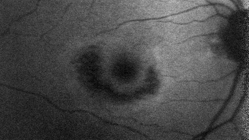 Hydroxychloroquine (plaquenil) Toxicity - Advanced
78 year old female No visual complaints referred for evaluation
Medical Hx: Rheumatoid Arthritis. Atrial Fibrillation. Benign Intracranial Hypertension. Sjogrens Syndrome. Osteoporosis. 
Systemic Meds: PLAQUENIL (Stopped 2 months ago). Leflunomide. Lidocaine. Gabapentin. Vitamin D. Multaq. DILTIAZEM.
VA OD: Dcc20/32-2 NccJ2
VA OS: Dcc20/25+1 NccJ1-1
IOP: TP: OD:14 OS:15 
Color Ishihara OD 9/11 correct, OS 9.5/11 correct
Weight 100 lbs, Height 4â€™ 2â€ tall.
1993 Plaquenil Initially 400 mg /day (9 mg/kg/day x 18 years) then 2011 200 mg daily - (4.6 mg/kg/day x 10 years) STOPPED 3/2021
The patient weighs 100 lbs and is 4â€™ 2â€ tall - Images are from 3/2021 and 5/2022
There was no progression 1 year after stopping plaquenil in this patient.
