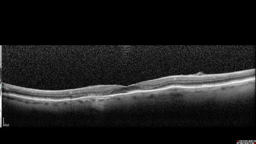 Hydroxychloroquine (plaquenil) Toxicity - Advanced
78 year old female No visual complaints referred for evaluation
Medical Hx: Rheumatoid Arthritis. Atrial Fibrillation. Benign Intracranial Hypertension. Sjogrens Syndrome. Osteoporosis. 
Systemic Meds: PLAQUENIL (Stopped 2 months ago). Leflunomide. Lidocaine. Gabapentin. Vitamin D. Multaq. DILTIAZEM.
VA OD: Dcc20/32-2 NccJ2
VA OS: Dcc20/25+1 NccJ1-1
IOP: TP: OD:14 OS:15 
Color Ishihara OD 9/11 correct, OS 9.5/11 correct
Weight 100 lbs, Height 4â€™ 2â€ tall.
1993 Plaquenil Initially 400 mg /day (9 mg/kg/day x 18 years) then 2011 200 mg daily - (4.6 mg/kg/day x 10 years) STOPPED 3/2021
The patient weighs 100 lbs and is 4â€™ 2â€ tall - Images are from 3/2021 and 5/2022
There was no progression 1 year after stopping plaquenil in this patient.
