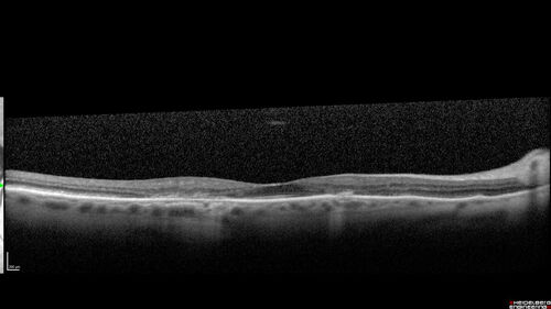 Hydroxychloroquine (plaquenil) Toxicity - Advanced
78 year old female No visual complaints referred for evaluation
Medical Hx: Rheumatoid Arthritis. Atrial Fibrillation. Benign Intracranial Hypertension. Sjogrens Syndrome. Osteoporosis. 
Systemic Meds: PLAQUENIL (Stopped 2 months ago). Leflunomide. Lidocaine. Gabapentin. Vitamin D. Multaq. DILTIAZEM.
VA OD: Dcc20/32-2 NccJ2
VA OS: Dcc20/25+1 NccJ1-1
IOP: TP: OD:14 OS:15 
Color Ishihara OD 9/11 correct, OS 9.5/11 correct
Weight 100 lbs, Height 4â€™ 2â€ tall.
1993 Plaquenil Initially 400 mg /day (9 mg/kg/day x 18 years) then 2011 200 mg daily - (4.6 mg/kg/day x 10 years) STOPPED 3/2021
The patient weighs 100 lbs and is 4â€™ 2â€ tall - Images are from 3/2021 and 5/2022
There was no progression 1 year after stopping plaquenil in this patient.
