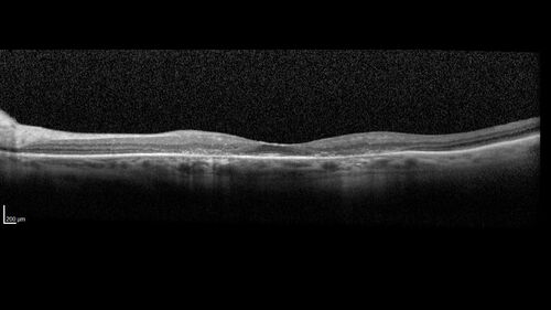 Hydroxychloroquine (plaquenil) Toxicity - Advanced
78 year old female No visual complaints referred for evaluation
Medical Hx: Rheumatoid Arthritis. Atrial Fibrillation. Benign Intracranial Hypertension. Sjogrens Syndrome. Osteoporosis. 
Systemic Meds: PLAQUENIL (Stopped 2 months ago). Leflunomide. Lidocaine. Gabapentin. Vitamin D. Multaq. DILTIAZEM.
VA OD: Dcc20/32-2 NccJ2
VA OS: Dcc20/25+1 NccJ1-1
IOP: TP: OD:14 OS:15 
Color Ishihara OD 9/11 correct, OS 9.5/11 correct
Weight 100 lbs, Height 4â€™ 2â€ tall.
1993 Plaquenil Initially 400 mg /day (9 mg/kg/day x 18 years) then 2011 200 mg daily - (4.6 mg/kg/day x 10 years) STOPPED 3/2021
The patient weighs 100 lbs and is 4â€™ 2â€ tall - Images are from 3/2021 and 5/2022
There was no progression 1 year after stopping plaquenil in this patient.
