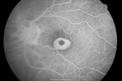 Plaquenil Toxicity - Bulls Eye Maculopathy
70-year-old woman with systemic Lupus erythematosus and clotting problems.  She was on the Plaquenil for about eight years and then off the Plaquenil for the last eight years because she developed macular toxicity.  Although her vision was hazy, it was stable. Recent deceased vision left eye: OD 20/60, OS 20/100.  IOP:  OD 18, OS 19.

Keywords: plaquenil;toxic retinopathy;toxic maculopathy;bulls eye;