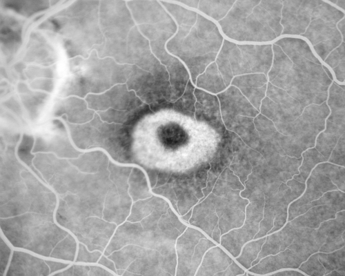 Plaquenil Toxicity - Bulls Eye Maculopathy
70-year-old woman with systemic Lupus erythematosus and clotting problems.  She was on the Plaquenil for about eight years and then off the Plaquenil for the last eight years because she developed macular toxicity.  Although her vision was hazy, it was stable. Recent deceased vision left eye: OD 20/60, OS 20/100.  IOP:  OD 18, OS 19.

Keywords: plaquenil;toxic retinopathy;toxic maculopathy;bulls eye;