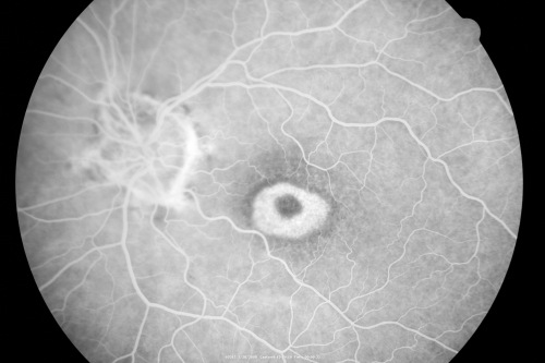 Plaquenil Toxicity - Bulls Eye Maculopathy
70-year-old woman with systemic Lupus erythematosus and clotting problems.  She was on the Plaquenil for about eight years and then off the Plaquenil for the last eight years because she developed macular toxicity.  Although her vision was hazy, it was stable. Recent deceased vision left eye: OD 20/60, OS 20/100.  IOP:  OD 18, OS 19.

Keywords: plaquenil;toxic retinopathy;toxic maculopathy;bulls eye;