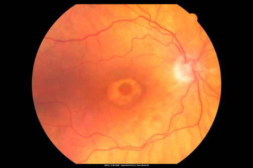 Plaquenil Toxicity - Bulls Eye Maculopathy
70-year-old woman with systemic Lupus erythematosus and clotting problems.  She was on the Plaquenil for about eight years and then off the Plaquenil for the last eight years because she developed macular toxicity.  Although her vision was hazy, it was stable. Recent deceased vision left eye: OD 20/60, OS 20/100.  IOP:  OD 18, OS 19.

Keywords: plaquenil;toxic retinopathy;toxic maculopathy;bulls eye;
