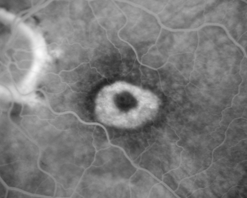 Plaquenil Toxicity - Bulls Eye Maculopathy
70-year-old woman with systemic Lupus erythematosus and clotting problems.  She was on the Plaquenil for about eight years and then off the Plaquenil for the last eight years because she developed macular toxicity.  Although her vision was hazy, it was stable. Recent deceased vision left eye: OD 20/60, OS 20/100.  IOP:  OD 18, OS 19.

Keywords: plaquenil;toxic retinopathy;toxic maculopathy;bulls eye;