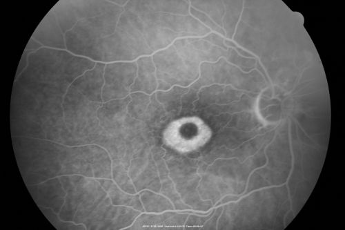 Plaquenil Toxicity - Bulls Eye Maculopathy
70-year-old woman with systemic Lupus erythematosus and clotting problems.  She was on the Plaquenil for about eight years and then off the Plaquenil for the last eight years because she developed macular toxicity.  Although her vision was hazy, it was stable. Recent deceased vision left eye: OD 20/60, OS 20/100.  IOP:  OD 18, OS 19.

Keywords: plaquenil;toxic retinopathy;toxic maculopathy;bulls eye;