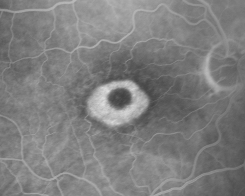 Plaquenil Toxicity - Bulls Eye Maculopathy
70-year-old woman with systemic Lupus erythematosus and clotting problems.  She was on the Plaquenil for about eight years and then off the Plaquenil for the last eight years because she developed macular toxicity.  Although her vision was hazy, it was stable. Recent deceased vision left eye: OD 20/60, OS 20/100.  IOP:  OD 18, OS 19.

Keywords: plaquenil;toxic retinopathy;toxic maculopathy;bulls eye;