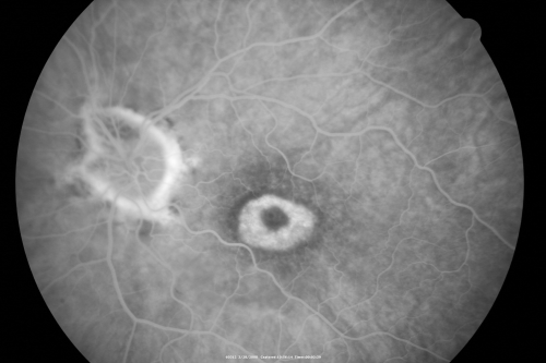 Plaquenil Toxicity - Bulls Eye Maculopathy
70-year-old woman with systemic Lupus erythematosus and clotting problems.  She was on the Plaquenil for about eight years and then off the Plaquenil for the last eight years because she developed macular toxicity.  Although her vision was hazy, it was stable. Recent deceased vision left eye: OD 20/60, OS 20/100.  IOP:  OD 18, OS 19.

Keywords: plaquenil;toxic retinopathy;toxic maculopathy;bulls eye;