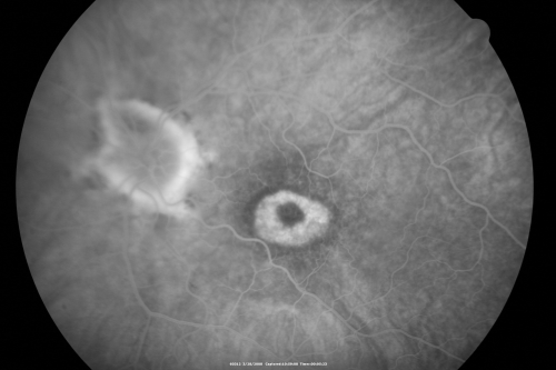 Plaquenil Toxicity - Bulls Eye Maculopathy
70-year-old woman with systemic Lupus erythematosus and clotting problems.  She was on the Plaquenil for about eight years and then off the Plaquenil for the last eight years because she developed macular toxicity.  Although her vision was hazy, it was stable. Recent deceased vision left eye: OD 20/60, OS 20/100.  IOP:  OD 18, OS 19.

Keywords: plaquenil;toxic retinopathy;toxic maculopathy;bulls eye;