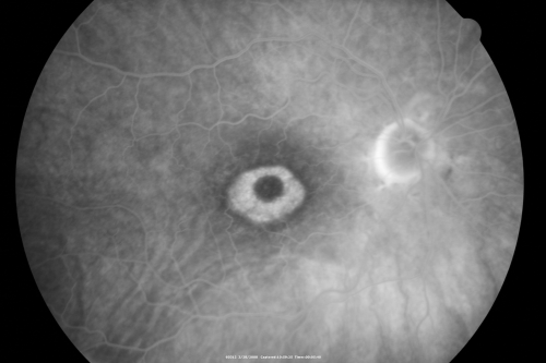 Plaquenil Toxicity - Bulls Eye Maculopathy
70-year-old woman with systemic Lupus erythematosus and clotting problems.  She was on the Plaquenil for about eight years and then off the Plaquenil for the last eight years because she developed macular toxicity.  Although her vision was hazy, it was stable. Recent deceased vision left eye: OD 20/60, OS 20/100.  IOP:  OD 18, OS 19.

Mots-clés: plaquenil;toxic retinopathy;toxic maculopathy;bulls eye;
