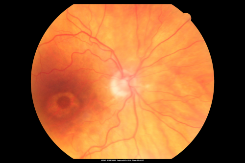 Plaquenil Toxicity - Bulls Eye Maculopathy
70-year-old woman with systemic Lupus erythematosus and clotting problems.  She was on the Plaquenil for about eight years and then off the Plaquenil for the last eight years because she developed macular toxicity.  Although her vision was hazy, it was stable. Recent deceased vision left eye: OD 20/60, OS 20/100.  IOP:  OD 18, OS 19.

Schlüsselwörter: plaquenil;toxic retinopathy;toxic maculopathy;bulls eye;