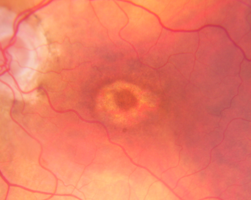 Plaquenil Toxicity - Bulls Eye Maculopathy
70-year-old woman with systemic Lupus erythematosus and clotting problems.  She was on the Plaquenil for about eight years and then off the Plaquenil for the last eight years because she developed macular toxicity.  Although her vision was hazy, it was stable. Recent deceased vision left eye: OD 20/60, OS 20/100.  IOP:  OD 18, OS 19.

Keywords: plaquenil;toxic retinopathy;toxic maculopathy;bulls eye;