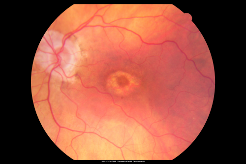 Plaquenil Toxicity - Bulls Eye Maculopathy
70-year-old woman with systemic Lupus erythematosus and clotting problems.  She was on the Plaquenil for about eight years and then off the Plaquenil for the last eight years because she developed macular toxicity.  Although her vision was hazy, it was stable. Recent deceased vision left eye: OD 20/60, OS 20/100.  IOP:  OD 18, OS 19.

