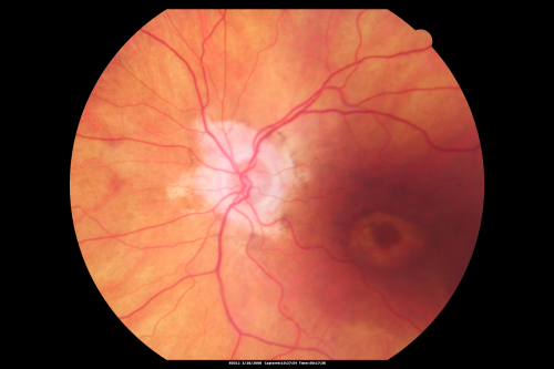 Plaquenil Toxicity - Bulls Eye Maculopathy
70-year-old woman with systemic Lupus erythematosus and clotting problems.  She was on the Plaquenil for about eight years and then off the Plaquenil for the last eight years because she developed macular toxicity.  Although her vision was hazy, it was stable. Recent deceased vision left eye: OD 20/60, OS 20/100.  IOP:  OD 18, OS 19.

Keywords: plaquenil;toxic retinopathy;toxic maculopathy;bulls eye;
