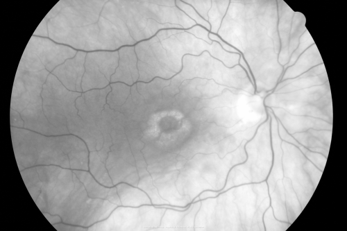 Plaquenil Toxicity - Bulls Eye Maculopathy
70-year-old woman with systemic Lupus erythematosus and clotting problems.  She was on the Plaquenil for about eight years and then off the Plaquenil for the last eight years because she developed macular toxicity.  Although her vision was hazy, it was stable. Recent deceased vision left eye: OD 20/60, OS 20/100.  IOP:  OD 18, OS 19.

Keywords: plaquenil;toxic retinopathy;toxic maculopathy;bulls eye;